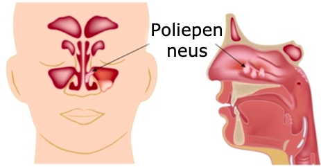 poliepen neus