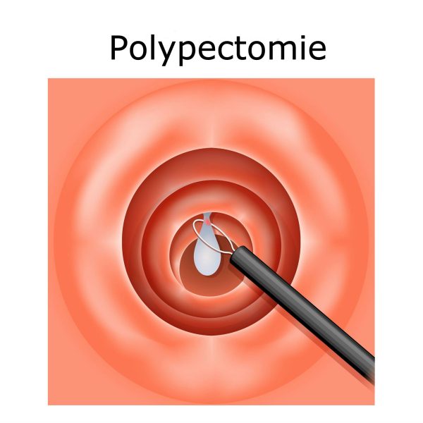 Polypectomie