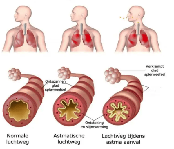 Astma aanval