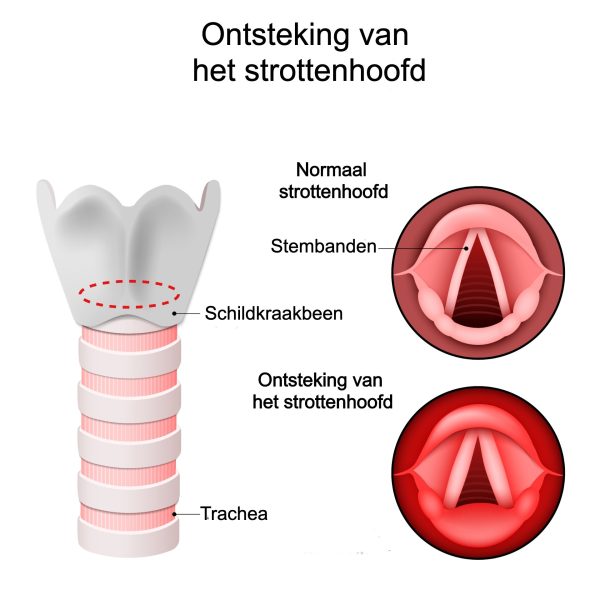 Ontsteking van het strottenhoofd