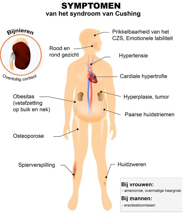 Syndroom van cushing