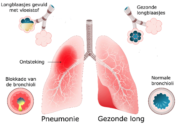 Pneumonie