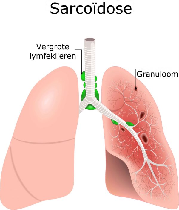 Sarcoïdose