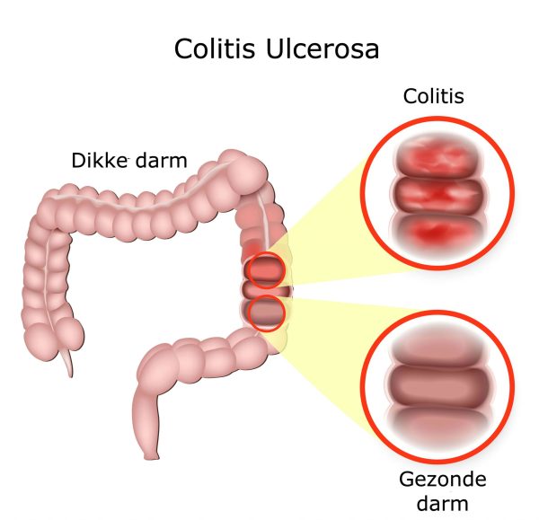 colitis ulcerosa